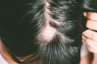 Spotty Hair Loss/Alopecia Areata Clinical Study