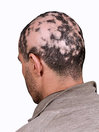 Alopecia Areata Clinical Study in Los Angeles